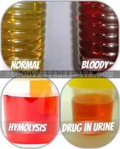 colors of bloody urine in kids