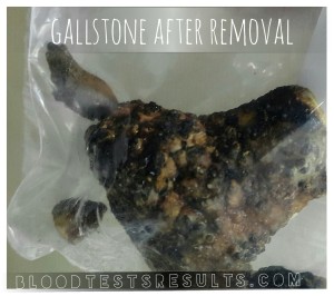 blood from gallstone