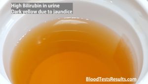 what does dark yellow jaundice urine look like?