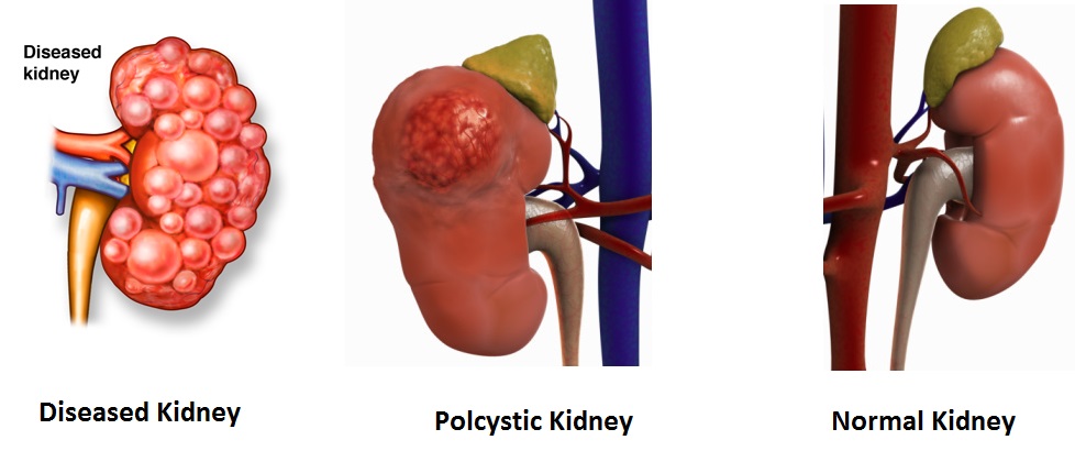 normal healthy kidneys vs polcystic and nephrotic