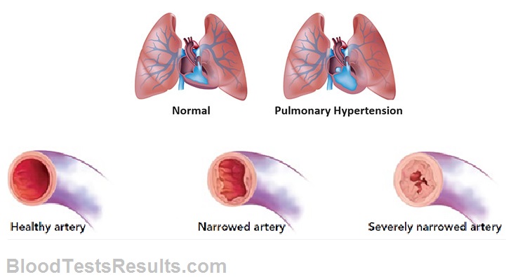 diff. between normal and PAH lungs and  arteries 